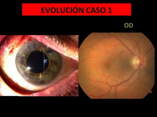 OD
EVOLUCIÓN CASO 1
 