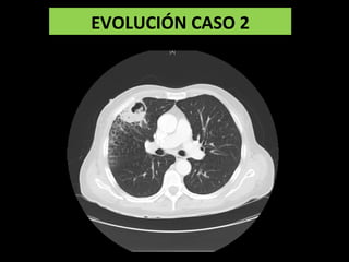 EVOLUCIÓN CASO 2
 