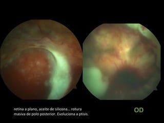 ODretina a plano, aceite de silicona… rotura
masiva de polo posterior. Evoluciona a ptisis.
 