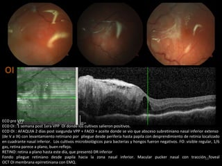 OI
53
ECO pre VPP
ECO OI : 1 semana post 1era VPP OI donde los cultivos salieron positivos.
ECO OI : AFAQUIA 2 días post ssegunda VPP + FACO + aceite donde se vio que absceso subretiniano nasal inferior extenso
(de V a IX) con levantamiento retiniano por pliegue desde perifería hasta papila con desprendimiento de retinia localizado
en cuadrante nasal inferior. Los cultivos microbiológicos para bacterias y hongos fueron negativos. FO: visible regular, 1/6
gas, retina parece a plano, buen reflejo.
RETINO: retina a plano hasta este día, que presentó DR inferior
Fondo pliegue retiniano desde papila hacia la zona nasal inferior. Macular pucker nasal con tracción foveal
OCT OI membrana epirretiniana con EMQ.
 