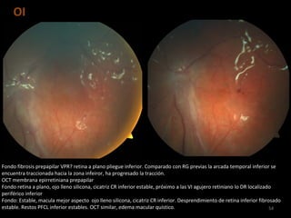 OI
54
Fondo fibrosis prepapilar VPR? retina a plano pliegue inferior. Comparado con RG previas la arcada temporal inferior se
encuentra traccionada hacia la zona infeiror, ha progresado la tracción.
OCT membrana epirretiniana prepapilar
Fondo retina a plano, ojo lleno silicona, cicatriz CR inferior estable, próximo a las VI agujero retiniano lo DR localizado
periférico inferior
Fondo: Estable, macula mejor aspecto ojo lleno silicona, cicatriz CR inferior. Desprendimiento de retina inferior fibrosado
estable. Restos PFCL inferior estables. OCT similar, edema macular quístico.
 