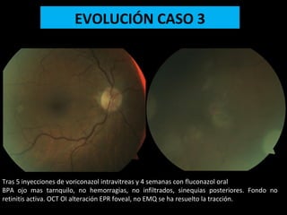 EVOLUCIÓN CASO 3
Tras 5 inyecciones de voriconazol intravitreas y 4 semanas con fluconazol oral
BPA ojo mas tarnquilo, no hemorragias, no infiltrados, sinequias posteriores. Fondo no
retinitis activa. OCT OI alteración EPR foveal, no EMQ se ha resuelto la tracción.
 