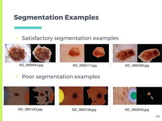 Skin Lesion Detection from Dermoscopic Images using Convolutional ...