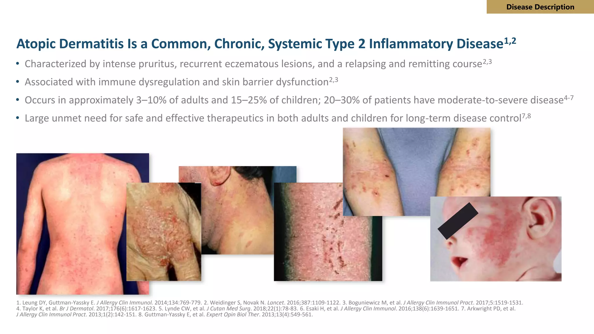 SA algorithm for eczema treatment Final | PPT