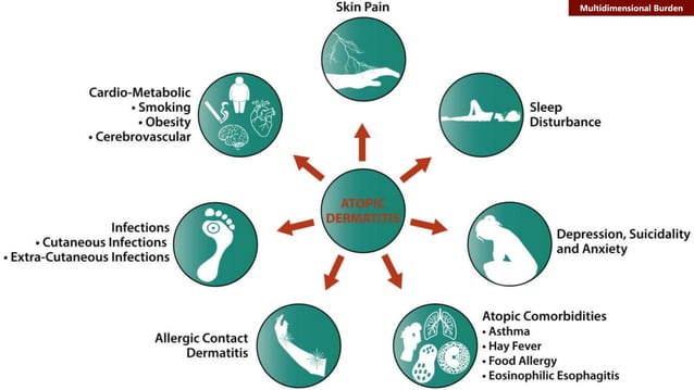 SA algorithm for eczema treatment Final | PPT