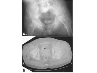 Tabular Rings adult-acetabular-fracture pelvic ring fracture | PPT