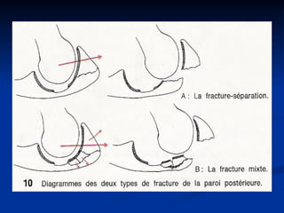 Tabular Rings adult-acetabular-fracture pelvic ring fracture | PPT
