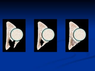 Tabular Rings adult-acetabular-fracture pelvic ring fracture | PPT