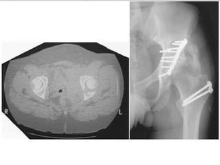 Tabular Rings adult-acetabular-fracture pelvic ring fracture | PPT