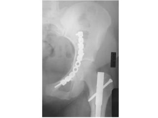 Tabular Rings adult-acetabular-fracture pelvic ring fracture | PPT