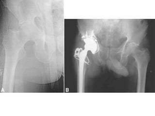 Tabular Rings adult-acetabular-fracture pelvic ring fracture | PPT