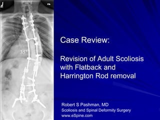 Case Review:
35°
      Revision of Adult Scoliosis
      with Flatback and
      Harrington Rod removal


      Robert S Pashman, MD
      Scoliosis and Spinal Deformity Surgery
      www.eSpine.com
 