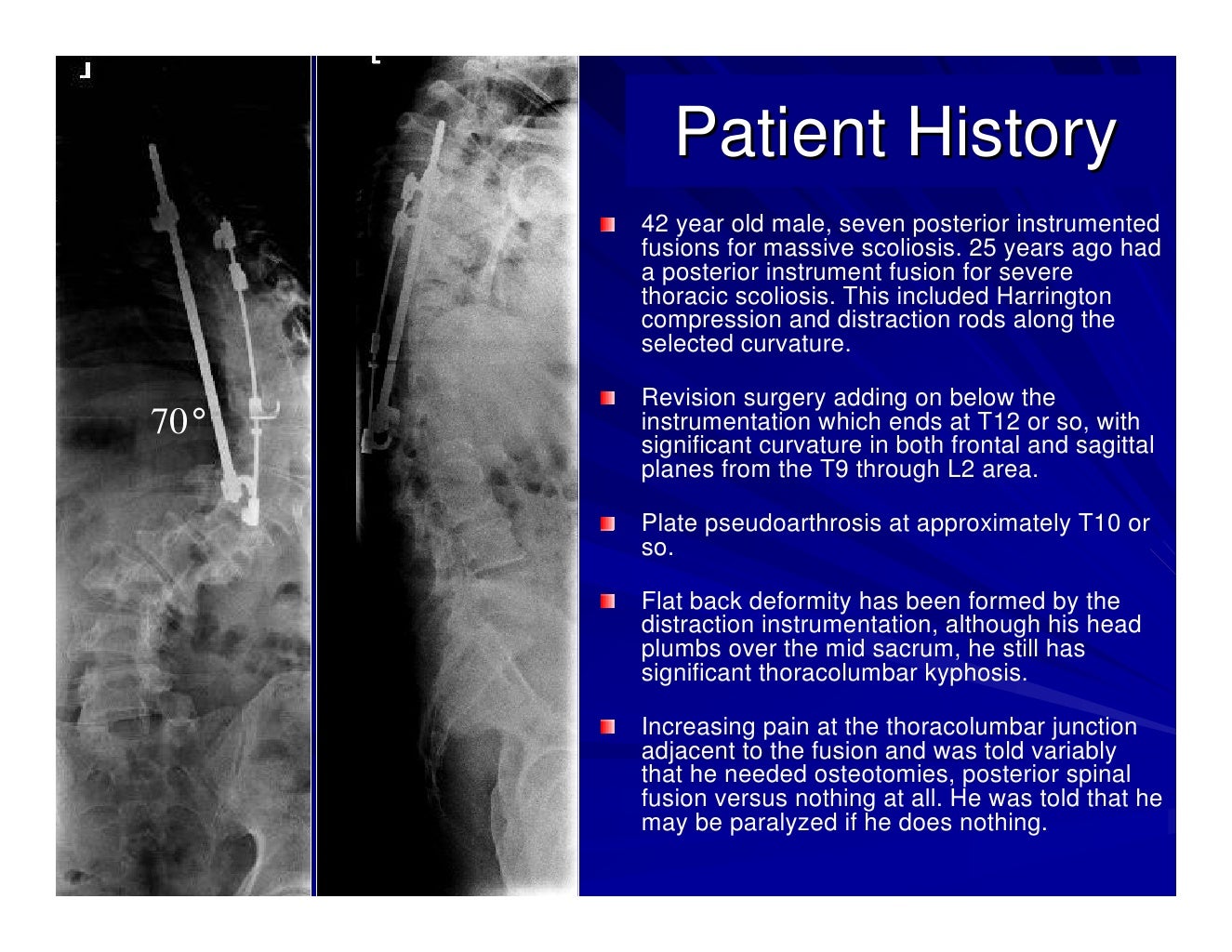 Case Review 1 42 year old make with Adult Scoliosis Harrington Rod