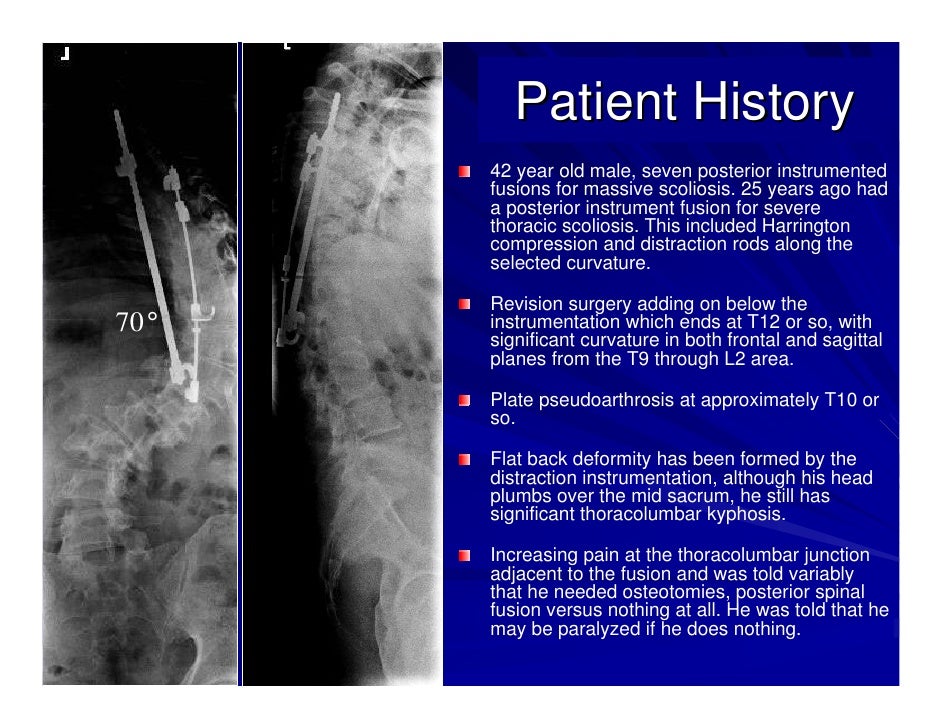 Case Review 1 42 year old make with Adult Scoliosis