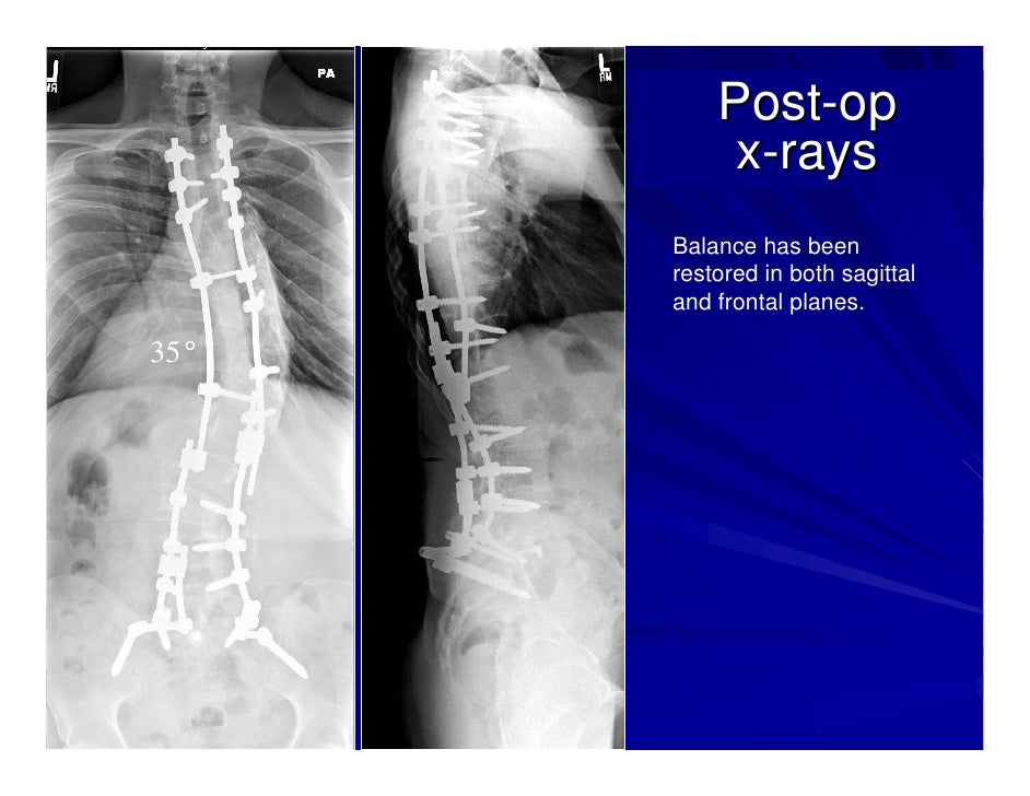 Case Review 1 42 year old make with Adult Scoliosis Harrington Rod