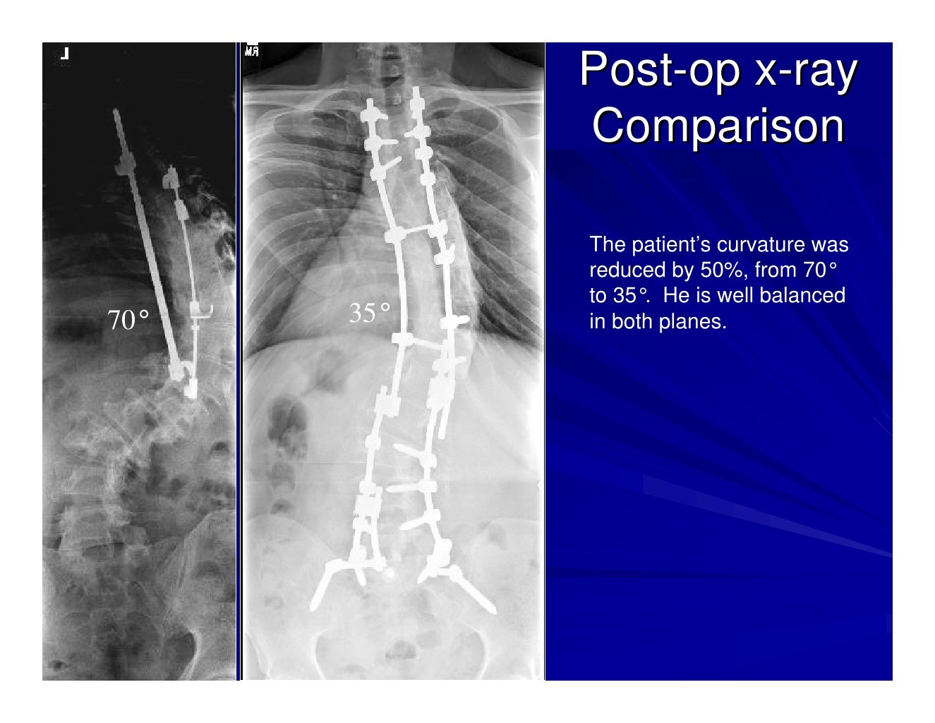 Case Review 1 42 year old make with Adult Scoliosis Harrington Rod