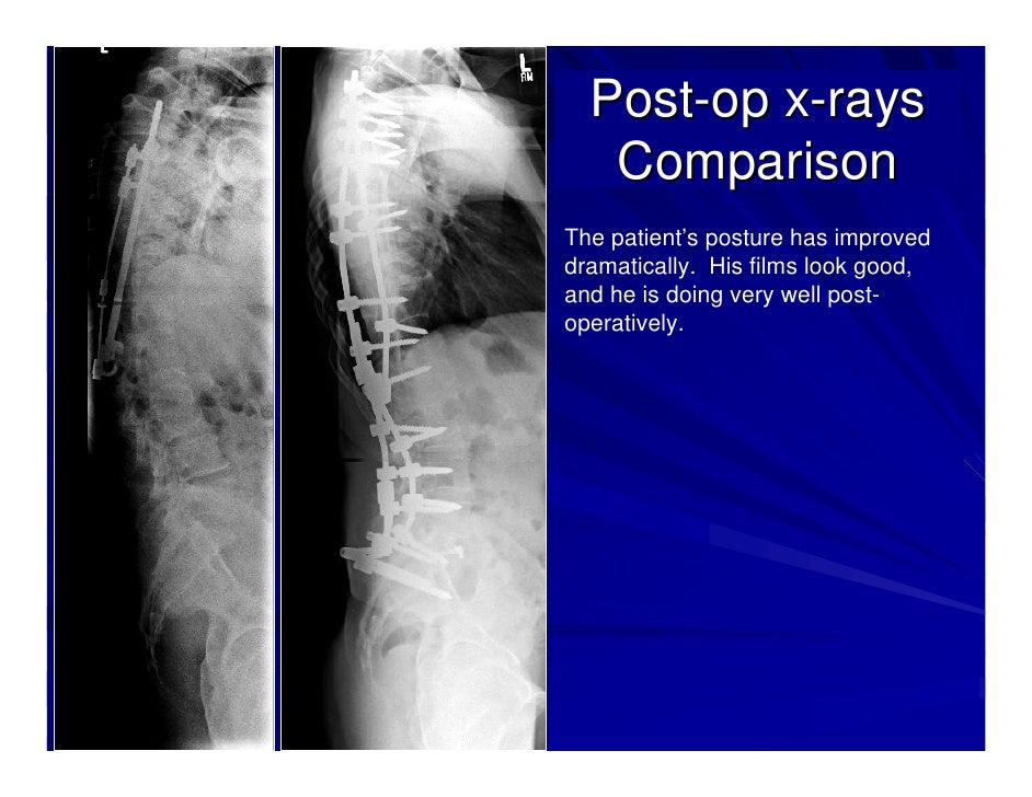 Case Review 1 42 year old make with Adult Scoliosis Harrington Rod