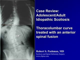 Case Review:
            Adolescent/Adult
34°         Idiopathic Scoliosis

            Thoracolumbar curve
            treated with an anterior
      48°   spinal fusion



            Robert S. Pashman, MD
            Scoliosis and Spinal Deformity Surgery
            www.eSpine.com
 