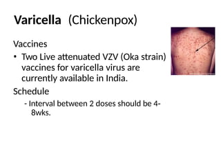 Varicella (Chickenpox)
Vaccines
• Two Live attenuated VZV (Oka strain)
vaccines for varicella virus are
currently available in India.
Schedule
- Interval between 2 doses should be 4-
8wks.
 