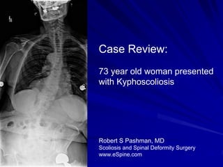 Case Review:
73 year old woman presented
with Kyphoscoliosis




Robert S Pashman, MD
Scoliosis and Spinal Deformity Surgery
www.eSpine.com
 
