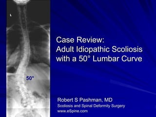 Case Review:
      Adult Idiopathic Scoliosis
      with a 50° Lumbar Curve

50°



      Robert S Pashman, MD
      Scoliosis and Spinal Deformity Surgery
      www.eSpine.com
 