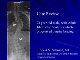 Case Review:
            21 year old male, with Adult
60°
            Idiopathic Scoliosis which
            progressed despite bracing.

      42°



            Robert S Pashman, MD
            Scoliosis and Spinal Deformity Surgery
            www.eSpine.com
 