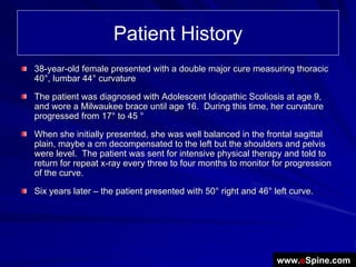 Patient History
38-year-old female presented with a double major cure measuring thoracic
40°, lumbar 44° curvature

The patient was diagnosed with Adolescent Idiopathic Scoliosis at age 9,
and wore a Milwaukee brace until age 16. During this time, her curvature
progressed from 17° to 45 °

When she initially presented, she was well balanced in the frontal sagittal
plain, maybe a cm decompensated to the left but the shoulders and pelvis
were level. The patient was sent for intensive physical therapy and told to
return for repeat x-ray every three to four months to monitor for progression
of the curve.

Six years later – the patient presented with 50° right and 46° left curve.




                                                                www.eSpine.com
 
