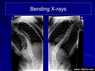 Bending X-rays
L                         R




                     www.eSpine.com
 