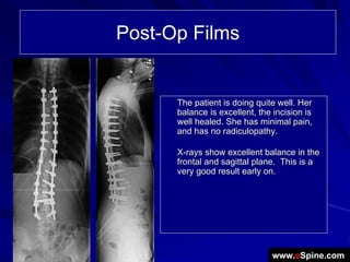 Post-Op Films


      The patient is doing quite well. Her
      balance is excellent, the incision is
      well healed. She has minimal pain,
      and has no radiculopathy.

      X-rays show excellent balance in the
      frontal and sagittal plane. This is a
      very good result early on.




                               www.eSpine.com
 