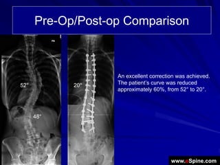 Pre-Op/Post-op Comparison



                   An excellent correction was achieved.
52°         20°    The patient’s curve was reduced
                   approximately 60%, from 52° to 20°.



      48°




                                        www.eSpine.com
 