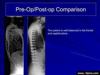 Pre-Op/Post-op Comparison


           The patient is well balanced in the frontal
           and sagittal plane.




                                       www.eSpine.com
 