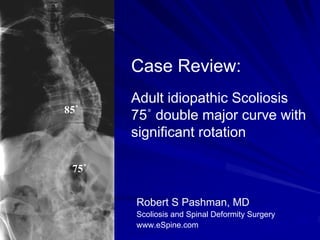 Case Review:
       Adult idiopathic Scoliosis
85˚
       75˚ double major curve with
       significant rotation

 75˚


       Robert S Pashman, MD
       Scoliosis and Spinal Deformity Surgery
       www.eSpine.com
 