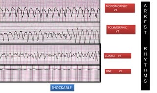 MONOMORPHIC
VT
POLYMORPHIC
VT
COARSE VF
FINE VF
A
R
R
E
S
T
R
H
Y
T
H
M
S
SHOCKABLE
 