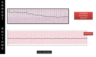 PULSELESS
ELECTRICAL
ACTIVITY
ASYSTOLE
A
R
R
E
S
T
R
H
Y
T
H
M
S
NON-SHOCKABLE
 