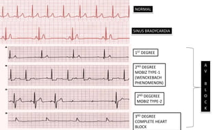 NORMAL
SINUS BRADYCARDIA
1ST DEGREE
2ND DEGREE
MOBIZ TYPE-1
(WENCKEBACH
PHENOMENON)
2ND DEGEREE
MOBIZ TYPE-2
3RD DEGREE
COMPLETE HEART
BLOCK
A
V
B
L
O
C
K
 
