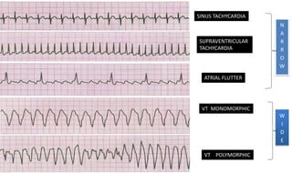 SINUS TACHYCARDIA
SUPRAVENTRICULAR
TACHYCARDIA
ATRIAL FLUTTER
VT MONOMORPHIC
VT POLYMORPHIC
N
A
R
R
O
W
W
I
D
E
 