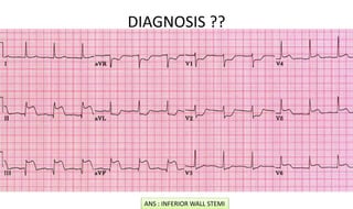 DIAGNOSIS ??
ANS : INFERIOR WALL STEMI
 