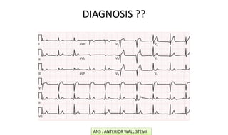 DIAGNOSIS ??
ANS : ANTERIOR WALL STEMI
 