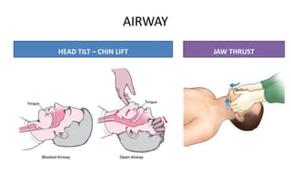 AIRWAY
HEAD TILT – CHIN LIFT JAW THRUST
 