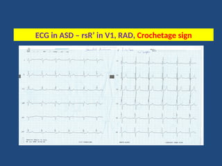 Rad Ecg Example Adult Congenital Heart Disease: Core Concepts | PPT