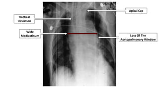 Wide
Mediastinum Loss Of The
Aortopulmonary Window
Tracheal
Deviation
Apical Cap
Depressed Left
Mainstem Bronchus
 