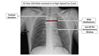 32-Year-Old Male Involved In A High-Speed Car Crash
Tracheal
Deviation
Wide
Mediastinum
Loss Of The
Aortopulmonary
Window
 