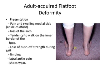 Adult-acquired Flatfoot
Deformity
• Presentation
- Pain and swelling medial side
(ankle-midfoot)
- loss of the arch
- Tendency to walk on the inner
border of the
foot.
- Loss of push-off strength during
gait
- limping
- latral ankle pain
- shoes wear.
 
