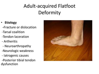 Adult-acquired Flatfoot
Deformity
• Etiology
-Fracture or dislocation
-Tarsal coalition
-Tendon laceration
- Artheritis
- Neuroarthropathy
-Neurologic weakness
- Iatrogenic causes
-Posterior tibial tendon
dysfunction
 
