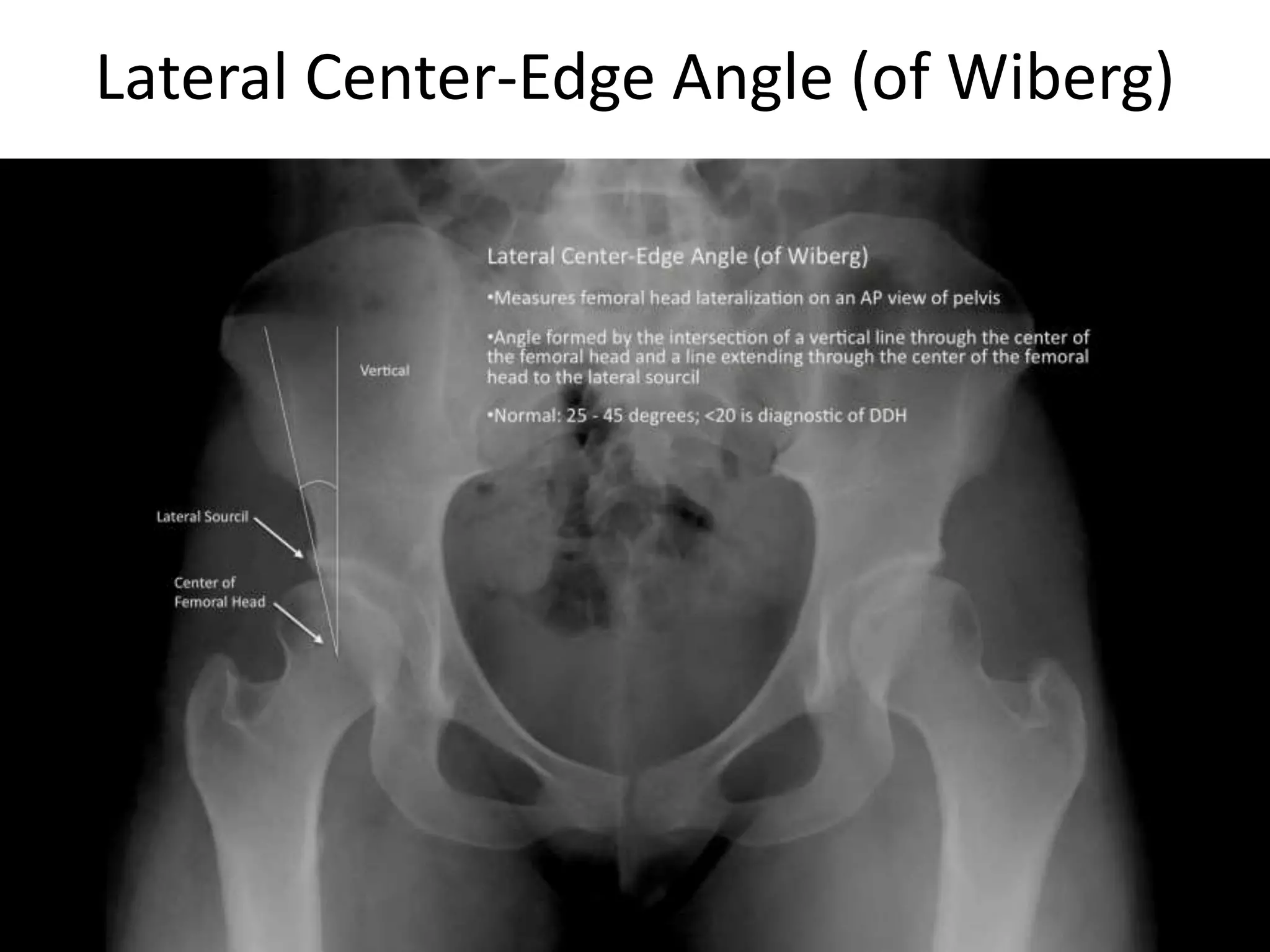 Adult hip dysplasia | PPTX
