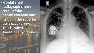Pacemaker Widdler Adult Lines and Tubes in Radiology | PPTX