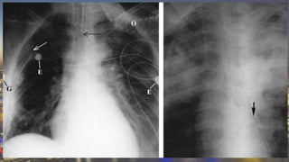 Adult Lines and Tubes in Radiology | PPTX