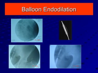 Balloon EndodilationBalloon Endodilation
 