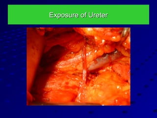 Exposure of UreterExposure of Ureter
 