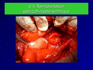 U.V.ReimplantationU.V.Reimplantation
split cuff-nipple techniquesplit cuff-nipple technique
 